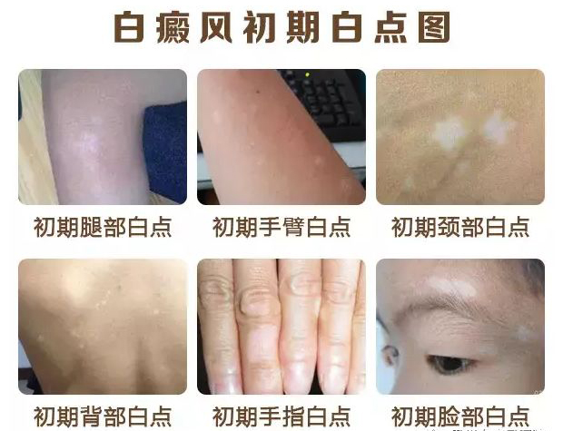 毕竟在处于白癜风这个病变过程中,是由于色素减退而引起的皮肤变白